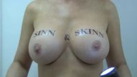 Breast Implants Glowing In The Dark
