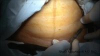 How A C-section Is Done.