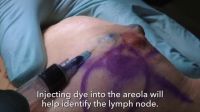 Lumpectomy And High-dose Radiation To Treat Breast Cancer