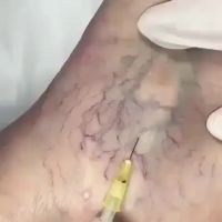 Sclerotherapy.